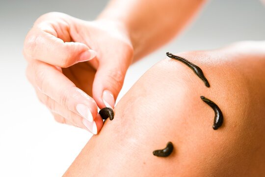 Leech Therapy in Siliguri – Natural Healing at Dr Biva’s Wellness Integrated Centre